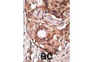 Formalin-fixed and paraffin-embedded human cancer tissue reacted with the primary antibody, which was peroxidase-conjugated to the secondary antibody, followed by DAB staining. (MAGEB2 抗体  (N-Term))