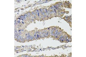 Immunohistochemistry of paraffin-embedded human colon carcinoma using UBE2S antibody. (UBE2S 抗体  (AA 122-221))