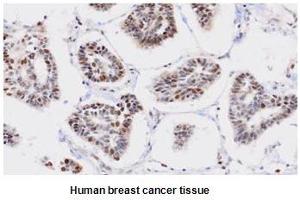Paraffin embedded sections of human breast cancer tissue were incubated with anti-human PPM1G (1:50) for 2 hours at room temperature. (PPM1G 抗体)