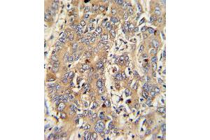 Formalin-fixed and paraffin-embedded human hepatocarcinoma with PIGR Antibody , which was peroxidase-conjugated to the secondary antibody, followed by DAB staining. (Stathmin 1 抗体  (C-Term))