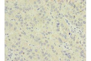 Immunohistochemistry of paraffin-embedded human liver cancer using ABIN7162044 at dilution of 1:100 (NME7 抗体  (AA 1-150))