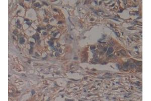 Detection of GCLM in Human Pancreatic cancer Tissue using Polyclonal Antibody to Glutamate Cysteine Ligase, Modifier Subunit (GCLM) (GCLM 抗体  (AA 40-251))