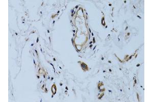 Immunohistochemistry of paraffin-embedded human colon carcinoma using MCAM antibody (ABIN6290150) at dilution of 1:100 (40x lens). (MCAM 抗体)