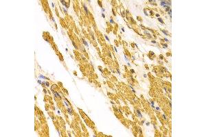 Immunohistochemistry of paraffin-embedded human gastric cancer using CYP2E1 antibody at dilution of 1:100 (x400 lens). (CYP2E1 抗体)