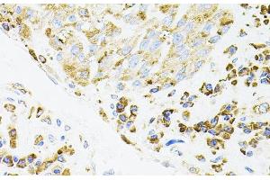 Immunohistochemistry of paraffin-embedded Human lung cancer using IRF1 Polyclonal Antibody (IRF1 抗体)