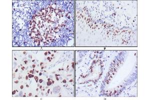 Immunohistochemical analysis of paraffin-embedded human lymph node (A), esophagus (B), lung cancer (C), rectum cancer (D), showing nuclear localization using KI67 antibody with DAB staining. (Ki-67 抗体)