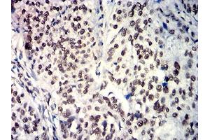 Immunohistochemical analysis of paraffin-embedded bladder cancer tissues using SOX11 mouse mAb with DAB staining. (SOX11 抗体  (AA 1-250))