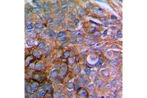 Immunohistochemical analysis of Paxillin staining in human prostate cancer formalin fixed paraffin embedded tissue section. (Paxillin 抗体  (N-Term))