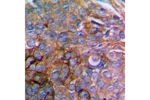 Immunohistochemical analysis of Paxillin staining in human prostate cancer formalin fixed paraffin embedded tissue section.