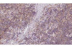 ABIN6273173 at 1/100 staining Human lymph cancer tissue by IHC-P. (SDC3 抗体)
