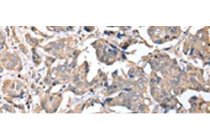 Immunohistochemistry of paraffin-embedded Human breast cancer tissue using KCTD16 Polyclonal Antibody at dilution of 1:25(x200) (KCTD16 抗体)
