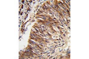 Formalin-fixed and paraffin-embedded human lung carcinoma reacted with ALDH3B1 Antibody (Center), which was peroxidase-conjugated to the secondary antibody, followed by DAB staining. (ALDH3B1 抗体  (AA 334-360))