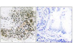 Immunohistochemistry analysis of paraffin-embedded human lung carcinoma tissue, using TRPS1 antibody. (TRPS1 抗体  (N-Term))