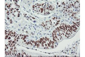 Immunohistochemical staining of paraffin-embedded Carcinoma of Human pancreas tissue using anti-TP53 mouse monoclonal antibody. (p53 抗体)