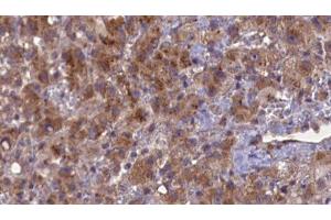 ABIN6276934 at 1/100 staining Human liver cancer tissue by IHC-P. (GABRB2 抗体  (N-Term))
