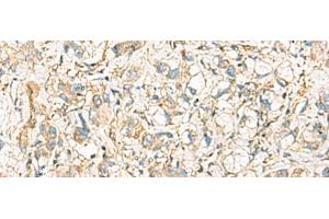Immunohistochemistry of paraffin-embedded Human liver cancer tissue using IDS Polyclonal Antibody at dilution of 1:60(x200)