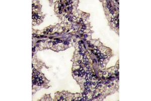 Formalin-fixed and paraffin-embedded prostata carcinoma tissue reacted with LTF Antibody (Center) (ABIN1882099 and ABIN2841775) , which was peroxidase-conjugated to the secondary antibody, followed by DAB staining. (Lactoferrin 抗体  (AA 219-248))