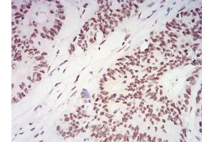 Immunohistochemical analysis of paraffin-embedded rectum cancer tissues using XRN2 mouse mAb with DAB staining.