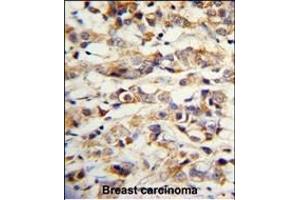 Formalin-fixed and paraffin-embedded human breast carcinoma with KRT14 Antibody (Center), which was peroxidase-conjugated to the secondary antibody, followed by DAB staining. (KRT14 抗体  (AA 276-303))