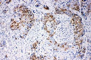 Anti-beta Arrestin 1 antibody, IHC(P) IHC(P): Human Mammary Cancer Tissue (beta Arrestin 1 抗体  (N-Term))