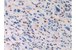 DAB staining on IHC-P;;Samples: Human Stomach cancer Tissue (PTGDS 抗体  (AA 1-199))