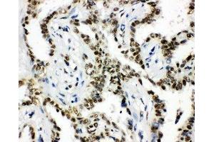 Anti-HDAC3 antibody,  IHC(P) IHC(P): Human Lung Cancer Tissue (HDAC3 抗体  (C-Term))