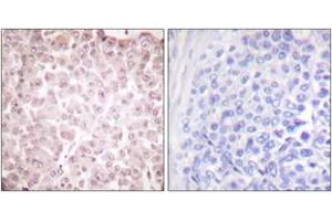 Immunohistochemistry analysis of paraffin-embedded human breast carcinoma tissue, using RCBTB1 Antibody. (RCBTB1 抗体  (AA 251-300))