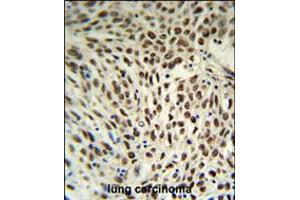 SNRPD3 Antibody IHC analysis in formalin fixed and paraffin embedded human lung carcinoma followed by peroxidase conjugation of the secondary antibody and DAB staining. (SNRPD3 抗体  (C-Term))