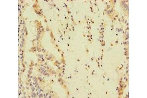 Immunohistochemistry of paraffin-embedded human lung cancer using ABIN7170492 at dilution of 1:100
