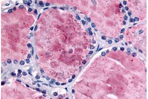 Human Thyroid (formalin-fixed, paraffin-embedded) stained with PDE8B antibody ABIN213536 at 5 ug/ml followed by biotinylated goat anti-rabbit IgG secondary antibody ABIN481713, alkaline phosphatase-streptavidin and chromogen. (PDE8B 抗体  (Internal Region))
