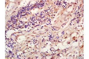 Formalin-fixed and paraffin embedded human lung carcinoma labeled with Anti-TRIB3 Polyclonal Antibody, Unconjugated (ABIN872793) at 1:200 followed by conjugation to the secondary antibody and DAB staining (TRIB3 抗体  (AA 201-300))