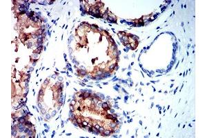 Immunohistochemical analysis of paraffin-embedded prostate cancer tissues using NEFH mouse mAb with DAB staining. (NEFH 抗体  (AA 2-251))