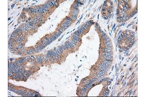 Immunohistochemical staining of paraffin-embedded Adenocarcinoma of Human colon tissue using anti-KHK mouse monoclonal antibody. (Ketohexokinase 抗体)