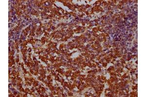IHC image of ABIN7145214 diluted at 1:100 and staining in paraffin-embedded human lung cancer performed on a Leica BondTM system. (BAG3 抗体  (AA 220-420))