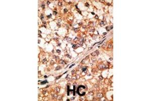 Formalin-fixed and paraffin-embedded human cancer tissue reacted with the primary antibody, which was peroxidase-conjugated to the secondary antibody, followed by DAB staining. (BIM 抗体  (AA 130-165))