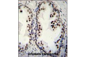 DDX27 Antibody immunohistochemistry analysis in formalin fixed and paraffin embedded human prsotate carcinoma followed by peroxidase conjugation of the secondary antibody and DAB staining. (DDX27 抗体  (C-Term))
