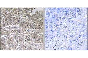 Immunohistochemistry analysis of paraffin-embedded human liver carcinoma tissue, using SLC25A21 Antibody.