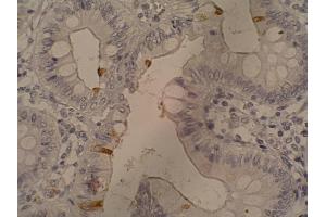 Immunohistochemistry staining of sialyl-Lewis a in colorectal adenocarcinoma (paraffin-embedded sections) with 121SLE antibody. (CA 19-9 抗体)