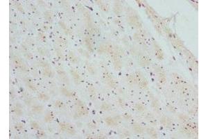 Immunohistochemistry of paraffin-embedded human colon cancer using ABIN7145457 at dilution of 1:100 (CTNNBL1 抗体  (AA 264-563))