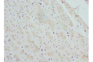 Immunohistochemistry of paraffin-embedded human colon cancer using ABIN7145457 at dilution of 1:100 (CTNNBL1 抗体  (AA 264-563))