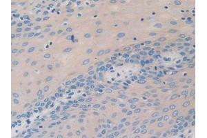 DAB staining on IHC-P; Samples: Human Stomach cancer Tissue (nectin-3 抗体  (AA 171-377))