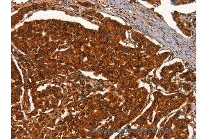 Immunohistochemistry of Human breast cancer using PRKD1 Polyclonal Antibody at dilution of 1:40 (PKC mu 抗体)