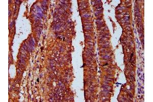 IHC image of ABIN7167644 diluted at 1:500 and staining in paraffin-embedded human colon cancer performed on a Leica BondTM system. (UPF3B 抗体  (AA 319-423))