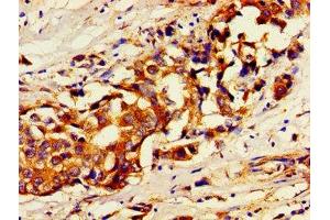 Immunohistochemistry of paraffin-embedded human breast cancer using ABIN7174356 at dilution of 1:100 (USP7 抗体  (C-Term))