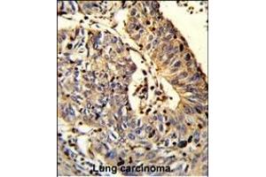 Formalin-fixed and paraffin-embedded human Lung carcinoma reacted with C21orf29 Antibody (Center), which was peroxidase-conjugated to the secondary antibody, followed by DAB staining. (TSPEAR 抗体  (AA 293-320))