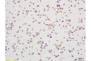 Formalin-fixed and paraffin embedded human glioma labeled with Rabbit Anti DATF1/IDO1 Polyclonal Antibody, Unconjugated  at 1:200 followed by conjugation to the secondary antibody and DAB staining