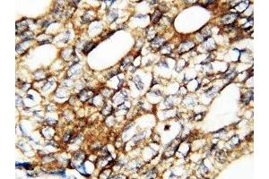 IHC-P: FGF1 antibody testing of human breast cancer tissue (FGF1 抗体  (AA 16-155))