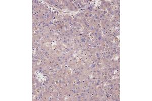 Immunohistochemical analysis of A on paraffin-embedded Human hepato carcinoma tissue. (PRKG1 抗体  (C-Term))