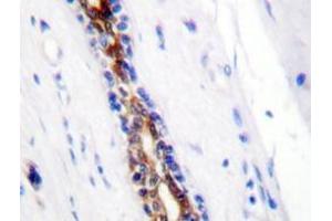 Immunohistochemistry analyzes of IRAK1 antibody in paraffin-embedded human breast carcinoma tissue. (IRAK1 抗体)