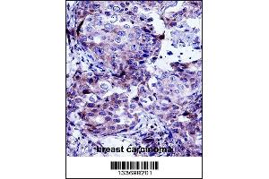 CTTN Antibody immunohistochemistry analysis in formalin fixed and paraffin embedded human breast carcinoma followed by peroxidase conjugation of the secondary antibody and DAB staining. (Cortactin 抗体  (AA 273-302))